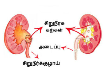 சிறுநீரகக்கல் என்றால் என்ன? வராமல் தடுப்பது  எப்படி ?
