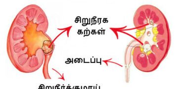 சிறுநீரகக்கல் என்றால் என்ன? வராமல் தடுப்பது  எப்படி ?