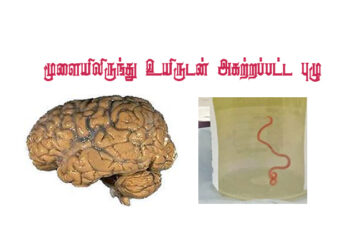 பெண்ணின் மூளையில் ஞாபக மறதியை ஏற்படுத்திய  புழு: அறுவை சிகிச்சை மூலம் உயிருடன் அகற்றம்…