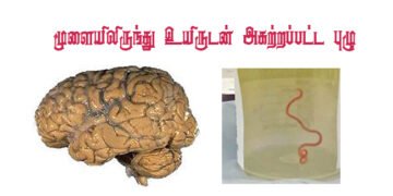 பெண்ணின் மூளையில் ஞாபக மறதியை ஏற்படுத்திய  புழு: அறுவை சிகிச்சை மூலம் உயிருடன் அகற்றம்…