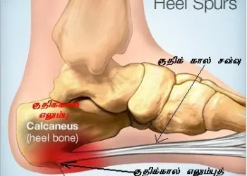 குதிக்கால் வலிக்கான ஆலோசனை.