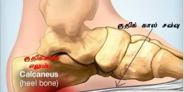 குதிக்கால் வலிக்கான ஆலோசனை.