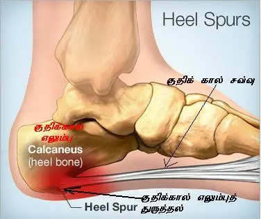 குதிக்கால் வலிக்கான ஆலோசனை.